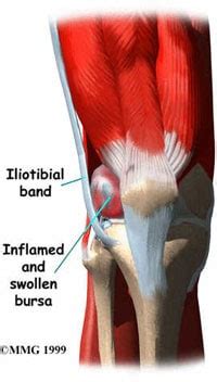 Iliotibial Pain | Burlington Orthotic Centre