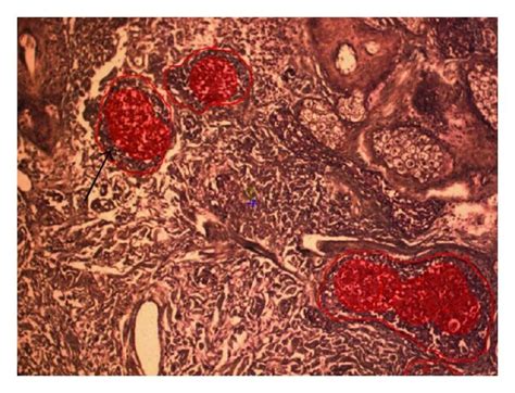 Representative example of histology of Merkel cell carcinoma from a... | Download Scientific Diagram