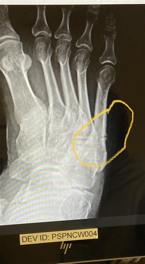 Jones Fracture : r/brokenbones