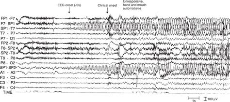 Focal Seizures with Impaired Consciousness | Neupsy Key