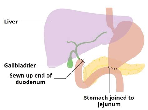 Peptic Ulcer Disease - Gastric - Duodenal - TeachMeSurgery