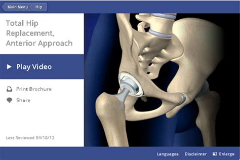 Anterior Total Hip Replacement