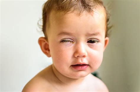 Conjunctivitis in Babies: Types, Identification and Treatment