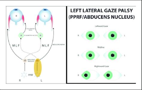 Paramedian Pontine Reticular Formation