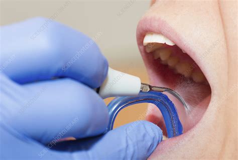 Removing dental tartar - Stock Image - F024/3990 - Science Photo Library