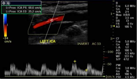 Carotid Ultrasound Quick Reference Guide