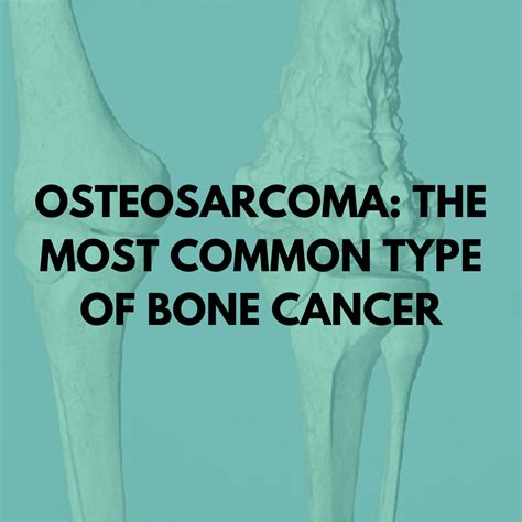 Osteosarcoma: the most common type of bone cancer - Niruja HealthTech