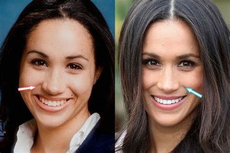 Meghan Markle Plastic Surgery – Nose Job, Teeth – before and after ...