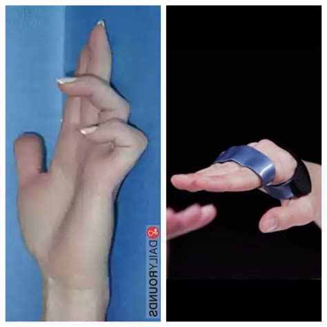 Pin by Brenda73 on Splints | Hand therapy, Occupational therapy, Ulnar ...