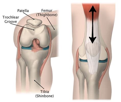 Patella Subluxation / Patella Dislocation - SportsFit Physio & Health