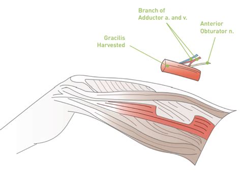 Gracilis Muscle Flap - Free Gracilis Muscle Transfer For Facial Paralysis