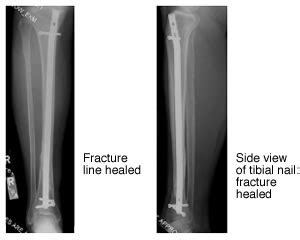 Im Nailing Tibia Procedure - Nail Ftempo