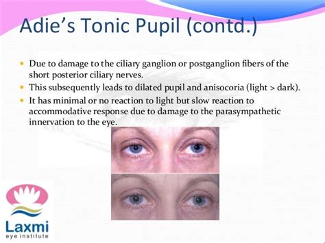 The pupillary pathway and its clinical aspects