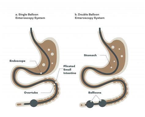 Deep Enteroscopy in Singapore - Gastrohealth Clinic | Dr Bhavesh