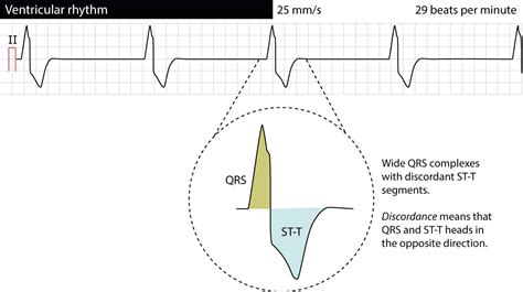 Ventricular rhythm and accelerated ventricular rhythm (idioventricular rhythm) – ECG learning