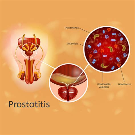 How to Do Prostate Massage for Prostatitis - kienitvc.ac.ke