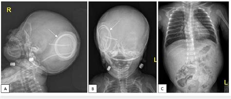 Before the second operation, VP shunt series, lateral (A) and anterior ...