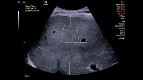 Liver Ultrasound Derived Fat Fraction (UDFF) White Paper Siemens ...