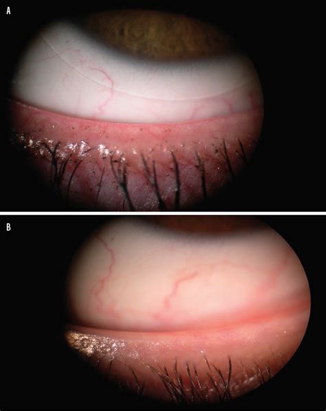 Enhance Your Dry Eye Practice With IPL - Modern Optometry