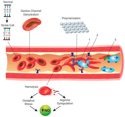 Sickle Cell Anemia Mutation