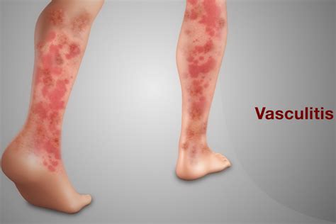 Vasculitis: Causes, Symptoms, Types and Treatment - ABTC