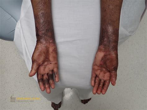 Pink scaring of bilateral palms with focal areas of erosion. (click ...