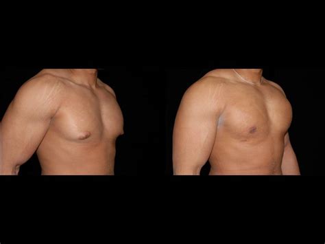 Gynecomastia Before and After | Premier Plastic Surgery