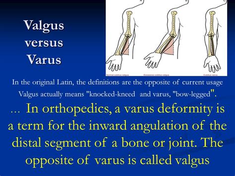 Varus Vs Valgus Fracture