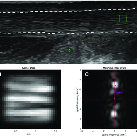 Frequency analyses of an Achilles tendon ultrasound image. (A) Original... | Download Scientific ...