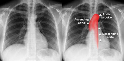 Aortic Dissection On Chest X Ray - vrogue.co