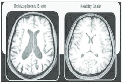 Difference of Schizophrenia Brain and Healthy Brain | Download Scientific Diagram