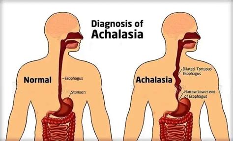 Achalasia: Understanding the Causes, Symptoms, and Treatment Options