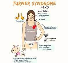 Turner Syndrome - Symptoms, Diagnosis, Treatment, Exercise