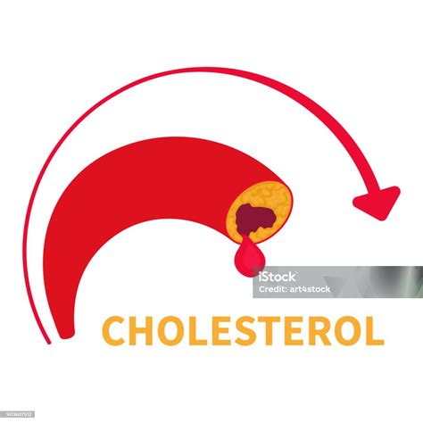 High Cholesterol Level Of Blocked Blood Vessel Diagram Stock ...