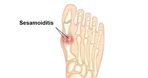 Sesamoiditis Symptoms & Treatment