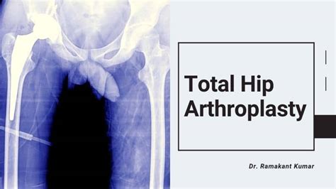 Total Hip Arthroplasty Definition: Procedure, Risks and Recovery