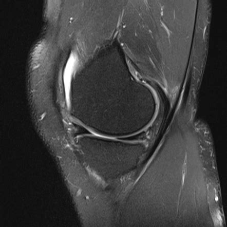 Ramp lesion (meniscus) | Radiology Reference Article | Radiopaedia.org