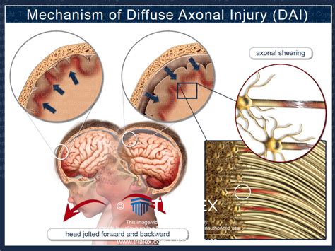 Mechanism of Diffuse Axonal Injury - TrialQuest Inc.