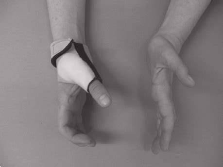 The neoprene thumb opposition splint positions the thumb more opposite... | Download Scientific ...