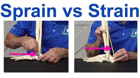 Sprain vs Strain: Understanding the Key Differences - YouTube