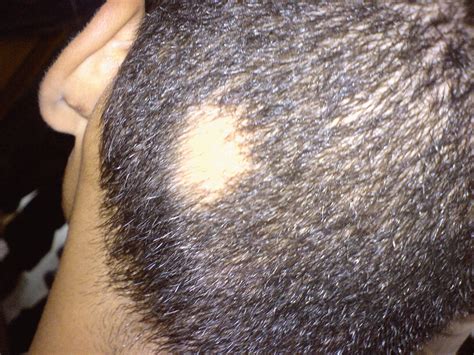 Alopecia areata - Wikipedia