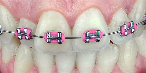 10 colored pink braces for charming teenage girls | Braces Explained