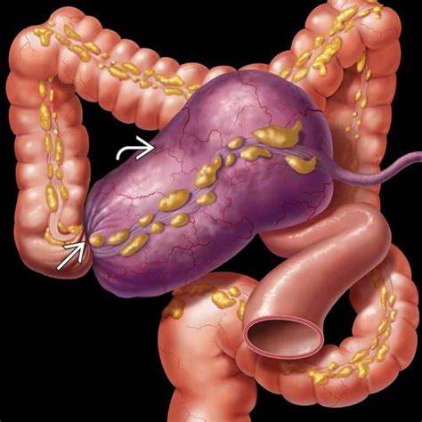 Cecal Volvulus | Radiology Key