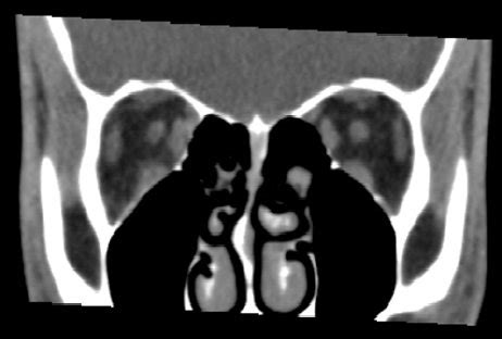 Coronal CT scan of the orbit at the mid orbit level showing normal ...