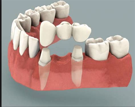 Dental Bridge Problems | SouthPointe Dental | Lincoln, NE