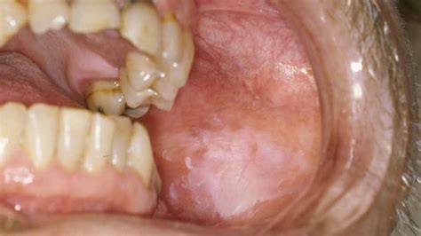 Mouth Sores: Pictures, Causes, Types, Symptoms, and Treatments