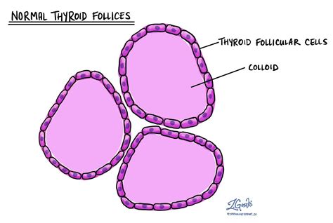 Nodular thyroid hyperplasia - MyPathologyReport.ca