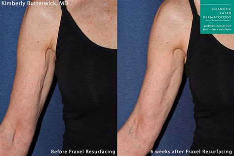 Crepey Skin Arm Treatment | San Diego, CA | CLDerm