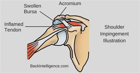 Shoulder Impingement Exercises You Can Do At Home