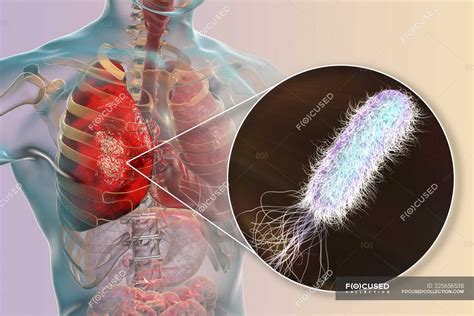 Polmonite causata da batterio Pseudomonas aeruginosa, illustrazione digitale . — tridimensionale ...